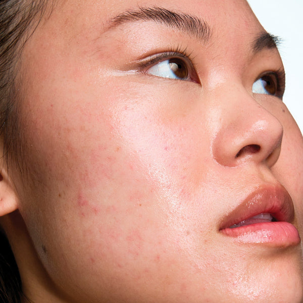 Long-term skin health for acne-prone skin: what your skin actually needs